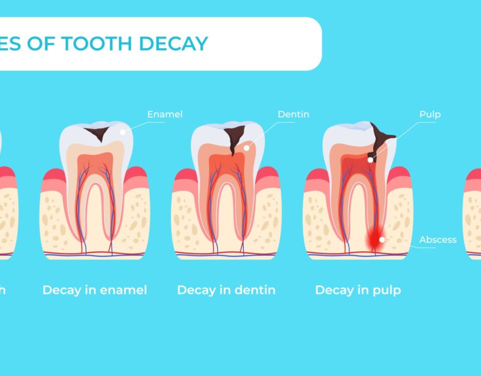Stage tooth decay infographic medical educational scheme names diagnosis vector flat illustration. Teeth formation steps, from healthy to deal, forming dental plaque caries in enamel, dentin and pulp